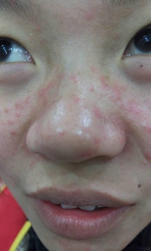 忽然吃瓜开始过敏了,揭秘“忽然吃瓜”背后的健康隐患